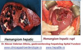 Hemangiom hepatic